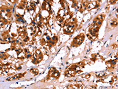 The image on the left is immunohistochemistry of paraffin-embedded Human thyroid cancer tissue using CSB-PA213286(CALB1 Antibody) at dilution 1/50, on the right is treated with fusion protein. (Original magnification: ×200)