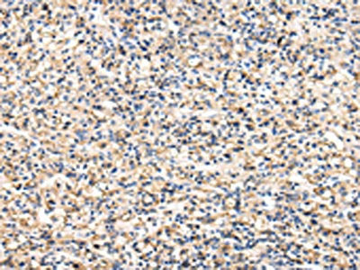 The image on the left is immunohistochemistry of paraffin-embedded Human prostate cancer tissue using CSB-PA213301(VCAM1 Antibody) at dilution 1/30, on the right is treated with fusion protein. (Original magnification: ×200)