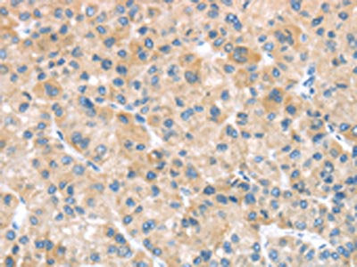 The image on the left is immunohistochemistry of paraffin-embedded Human liver cancer tissue using CSB-PA213445(SFTPA1 Antibody) at dilution 1/40, on the right is treated with fusion protein. (Original magnification: ×200)