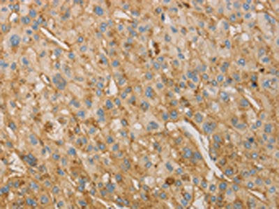 The image on the left is immunohistochemistry of paraffin-embedded Human liver cancer tissue using CSB-PA213506(VTN Antibody) at dilution 1/40, on the right is treated with fusion protein. (Original magnification: ×200)