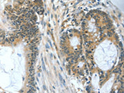 The image on the left is immunohistochemistry of paraffin-embedded Human colon cancer tissue using CSB-PA213653(BAD Antibody) at dilution 1/60, on the right is treated with fusion protein. (Original magnification: ×200)