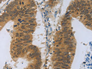 The image on the left is immunohistochemistry of paraffin-embedded Human colon cancer tissue using CSB-PA213664(TNFRSF11B Antibody) at dilution 1/30, on the right is treated with fusion protein. (Original magnification: ×200)