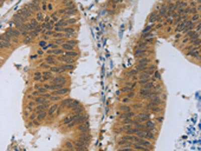 The image on the left is immunohistochemistry of paraffin-embedded Human colon cancer tissue using CSB-PA213664(TNFRSF11B Antibody) at dilution 1/30, on the right is treated with fusion protein. (Original magnification: ×200)