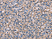 The image on the left is immunohistochemistry of paraffin-embedded Human prostate cancer tissue using CSB-PA213831(NMT2 Antibody) at dilution 1/20, on the right is treated with fusion protein. (Original magnification: ×200)