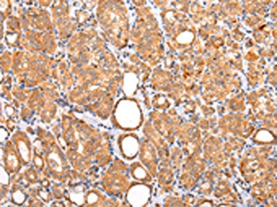 The image on the left is immunohistochemistry of paraffin-embedded Human thyroid cancer tissue using CSB-PA213838(ZNF420 Antibody) at dilution 1/20, on the right is treated with synthetic peptide. (Original magnification: ×200)