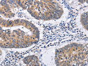 The image on the left is immunohistochemistry of paraffin-embedded Human colon cancer tissue using CSB-PA213853(RCHY1 Antibody) at dilution 1/30, on the right is treated with fusion protein. (Original magnification: ×200)