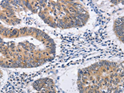 The image on the left is immunohistochemistry of paraffin-embedded Human colon cancer tissue using CSB-PA213853(RCHY1 Antibody) at dilution 1/30, on the right is treated with fusion protein. (Original magnification: ×200)