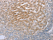 The image on the left is immunohistochemistry of paraffin-embedded Human liver cancer tissue using CSB-PA213899(TNFRSF25 Antibody) at dilution 1/20, on the right is treated with fusion protein. (Original magnification: ×200)