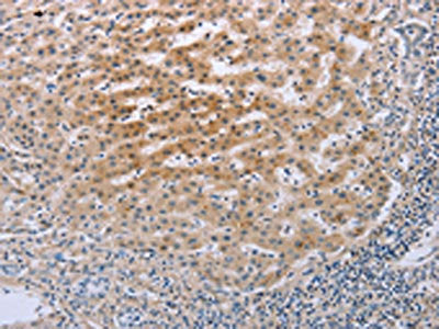 The image on the left is immunohistochemistry of paraffin-embedded Human liver cancer tissue using CSB-PA213899(TNFRSF25 Antibody) at dilution 1/20, on the right is treated with fusion protein. (Original magnification: ×200)
