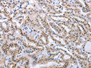 The image on the left is immunohistochemistry of paraffin-embedded Human thyroid cancer tissue using CSB-PA213924(PAX8 Antibody) at dilution 1/25, on the right is treated with fusion protein. (Original magnification: ×200)
