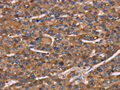 The image on the left is immunohistochemistry of paraffin-embedded Human liver cancer tissue using CSB-PA214212(NCSTN Antibody) at dilution 1/50, on the right is treated with fusion protein. (Original magnification: ×200)