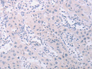 The image on the left is immunohistochemistry of paraffin-embedded Human lung cancer tissue using CSB-PA214505(PKD2L1 Antibody) at dilution 1/40, on the right is treated with synthetic peptide. (Original magnification: ×200)