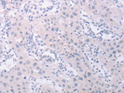 The image on the left is immunohistochemistry of paraffin-embedded Human lung cancer tissue using CSB-PA214505(PKD2L1 Antibody) at dilution 1/40, on the right is treated with synthetic peptide. (Original magnification: ×200)