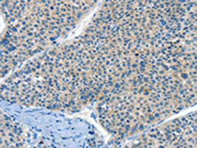 The image on the left is immunohistochemistry of paraffin-embedded Human liver cancer tissue using CSB-PA214508(HID1 Antibody) at dilution 1/50, on the right is treated with synthetic peptide. (Original magnification: ×200)