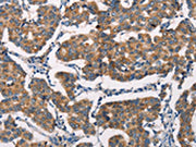 The image on the left is immunohistochemistry of paraffin-embedded Human breast cancer tissue using CSB-PA214577(SPR Antibody) at dilution 1/20, on the right is treated with synthetic peptide. (Original magnification: ×200)