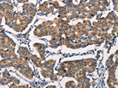 The image on the left is immunohistochemistry of paraffin-embedded Human breast cancer tissue using CSB-PA214577(SPR Antibody) at dilution 1/20, on the right is treated with synthetic peptide. (Original magnification: ×200)