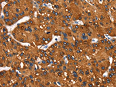 The image on the left is immunohistochemistry of paraffin-embedded Human liver cancer tissue using CSB-PA214597(MT-CYB Antibody) at dilution 1/50, on the right is treated with synthetic peptide. (Original magnification: ×200)