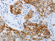 The image on the left is immunohistochemistry of paraffin-embedded Human lung cancer tissue using CSB-PA214644(P2RY4 Antibody) at dilution 1/30, on the right is treated with synthetic peptide. (Original magnification: ×200)