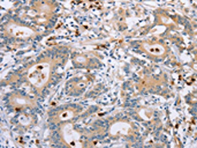 The image on the left is immunohistochemistry of paraffin-embedded Human colon cancer tissue using CSB-PA214768(KLK4 Antibody) at dilution 1/40, on the right is treated with fusion protein. (Original magnification: ×200)