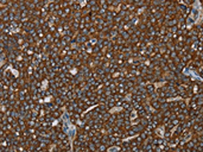 The image on the left is immunohistochemistry of paraffin-embedded Human ovarian cancer tissue using CSB-PA215070(GCKR Antibody) at dilution 1/40, on the right is treated with fusion protein. (Original magnification: ×200)