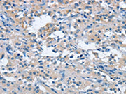 The image on the left is immunohistochemistry of paraffin-embedded Human thyroid cancer tissue using CSB-PA215086(FGF9 Antibody) at dilution 1/25, on the right is treated with fusion protein. (Original magnification: ×200)