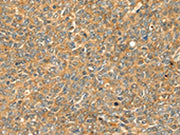 The image on the left is immunohistochemistry of paraffin-embedded Human ovarian cancer tissue using CSB-PA215100(GRB2 Antibody) at dilution 1/20, on the right is treated with fusion protein. (Original magnification: ×200)