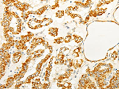 The image on the left is immunohistochemistry of paraffin-embedded Human thyroid cancer tissue using CSB-PA215116(FOXR2 Antibody) at dilution 1/25, on the right is treated with fusion protein. (Original magnification: ×200)