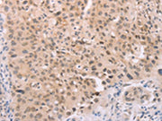 The image on the left is immunohistochemistry of paraffin-embedded Human lung cancer tissue using CSB-PA215248(ADAM11 Antibody) at dilution 1/25, on the right is treated with synthetic peptide. (Original magnification: ×200)