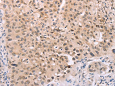 The image on the left is immunohistochemistry of paraffin-embedded Human lung cancer tissue using CSB-PA215248(ADAM11 Antibody) at dilution 1/25, on the right is treated with synthetic peptide. (Original magnification: ×200)