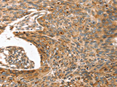 The image on the left is immunohistochemistry of paraffin-embedded Human esophagus cancer tissue using CSB-PA215261(ERVW-1 Antibody) at dilution 1/45, on the right is treated with synthetic peptide. (Original magnification: ×200)