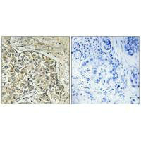 Immunohistochemistry analysis of paraffin-embedded human lung carcinoma tissue using ARSD antibody.
