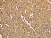 The image on the left is immunohistochemistry of paraffin-embedded Human liver cancer tissue using CSB-PA215588(CD40 Antibody) at dilution 1/70, on the right is treated with synthetic peptide. (Original magnification: ×200)