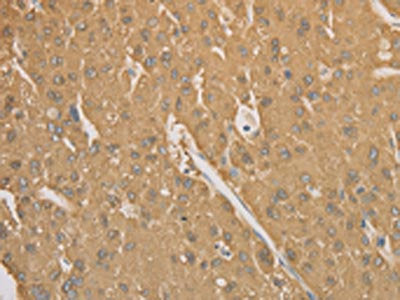The image on the left is immunohistochemistry of paraffin-embedded Human liver cancer tissue using CSB-PA215588(CD40 Antibody) at dilution 1/70, on the right is treated with synthetic peptide. (Original magnification: ×200)