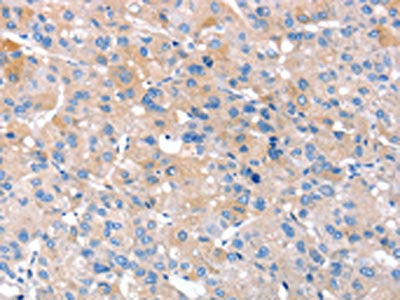 The image on the left is immunohistochemistry of paraffin-embedded Human liver cancer tissue using CSB-PA215699(RNF214 Antibody) at dilution 1/20, on the right is treated with fusion protein. (Original magnification: ×200)
