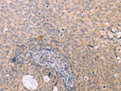 The image on the left is immunohistochemistry of paraffin-embedded Human cervical cancer tissue using CSB-PA215740(NAMPT Antibody) at dilution 1/15, on the right is treated with fusion protein. (Original magnification: ×200)