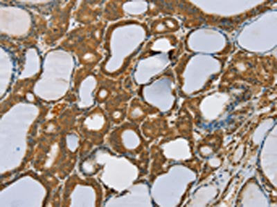The image on the left is immunohistochemistry of paraffin-embedded Human thyroid cancer tissue using CSB-PA215833(SENP1 Antibody) at dilution 1/35, on the right is treated with synthetic peptide. (Original magnification: ×200)