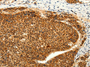 The image on the left is immunohistochemistry of paraffin-embedded Human liver cancer tissue using CSB-PA215862(TRPC6 Antibody) at dilution 1/50, on the right is treated with synthetic peptide. (Original magnification: ×200)