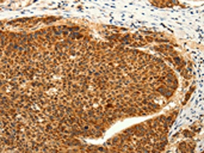The image on the left is immunohistochemistry of paraffin-embedded Human liver cancer tissue using CSB-PA215862(TRPC6 Antibody) at dilution 1/50, on the right is treated with synthetic peptide. (Original magnification: ×200)