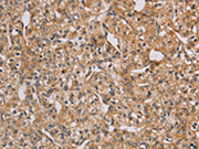 The image on the left is immunohistochemistry of paraffin-embedded Human prostate cancer tissue using CSB-PA215866(CHRNA4 Antibody) at dilution 1/20, on the right is treated with fusion protein. (Original magnification: ×200)
