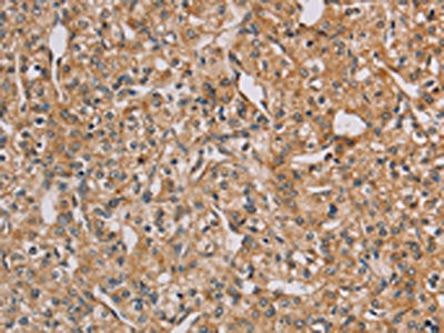 The image on the left is immunohistochemistry of paraffin-embedded Human prostate cancer tissue using CSB-PA215866(CHRNA4 Antibody) at dilution 1/20, on the right is treated with fusion protein. (Original magnification: ×200)