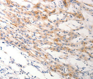 Immunohistochemical analysis of paraffin-embedded Human lung cancer tissue using.