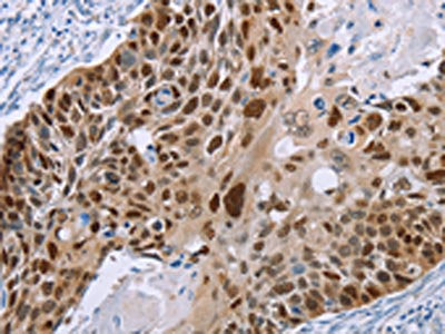 The image on the left is immunohistochemistry of paraffin-embedded Human esophagus cancer tissue using CSB-PA216191(MAGEA10 Antibody) at dilution 1/50, on the right is treated with fusion protein. (Original magnification: ×200)