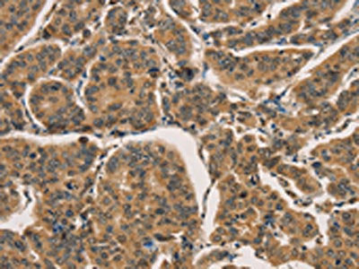 The image on the left is immunohistochemistry of paraffin-embedded Human breast cancer tissue using CSB-PA216273(CTNNBIP1 Antibody) at dilution 1/30, on the right is treated with fusion protein. (Original magnification: ×200)
