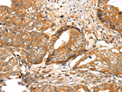 The image on the left is immunohistochemistry of paraffin-embedded Human esophagus cancer tissue using CSB-PA216533(LOXL4 Antibody) at dilution 1/35, on the right is treated with synthetic peptide. (Original magnification: ×200)