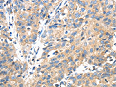 The image on the left is immunohistochemistry of paraffin-embedded Human breast cancer tissue using CSB-PA216572(TSC2 Antibody) at dilution 1/35, on the right is treated with synthetic peptide. (Original magnification: ×200)