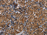 The image on the left is immunohistochemistry of paraffin-embedded Human thyroid cancer tissue using CSB-PA216653(TRPV1 Antibody) at dilution 1/20, on the right is treated with synthetic peptide. (Original magnification: ×200)