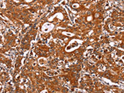 The image on the left is immunohistochemistry of paraffin-embedded Human gastic cancer tissue using CSB-PA216671(ICAM3 Antibody) at dilution 1/20, on the right is treated with synthetic peptide. (Original magnification: ×200)