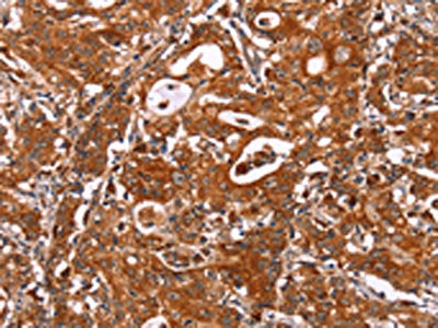 The image on the left is immunohistochemistry of paraffin-embedded Human gastic cancer tissue using CSB-PA216671(ICAM3 Antibody) at dilution 1/20, on the right is treated with synthetic peptide. (Original magnification: ×200)