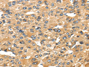 The image on the left is immunohistochemistry of paraffin-embedded Human liver cancer tissue using CSB-PA216676(UCP1 Antibody) at dilution 1/40, on the right is treated with synthetic peptide. (Original magnification: ×200)