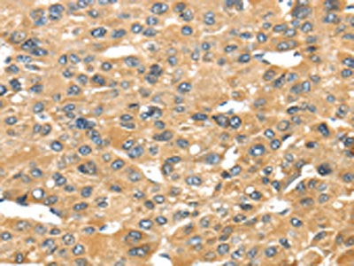 The image on the left is immunohistochemistry of paraffin-embedded Human liver cancer tissue using CSB-PA216676(UCP1 Antibody) at dilution 1/40, on the right is treated with synthetic peptide. (Original magnification: ×200)